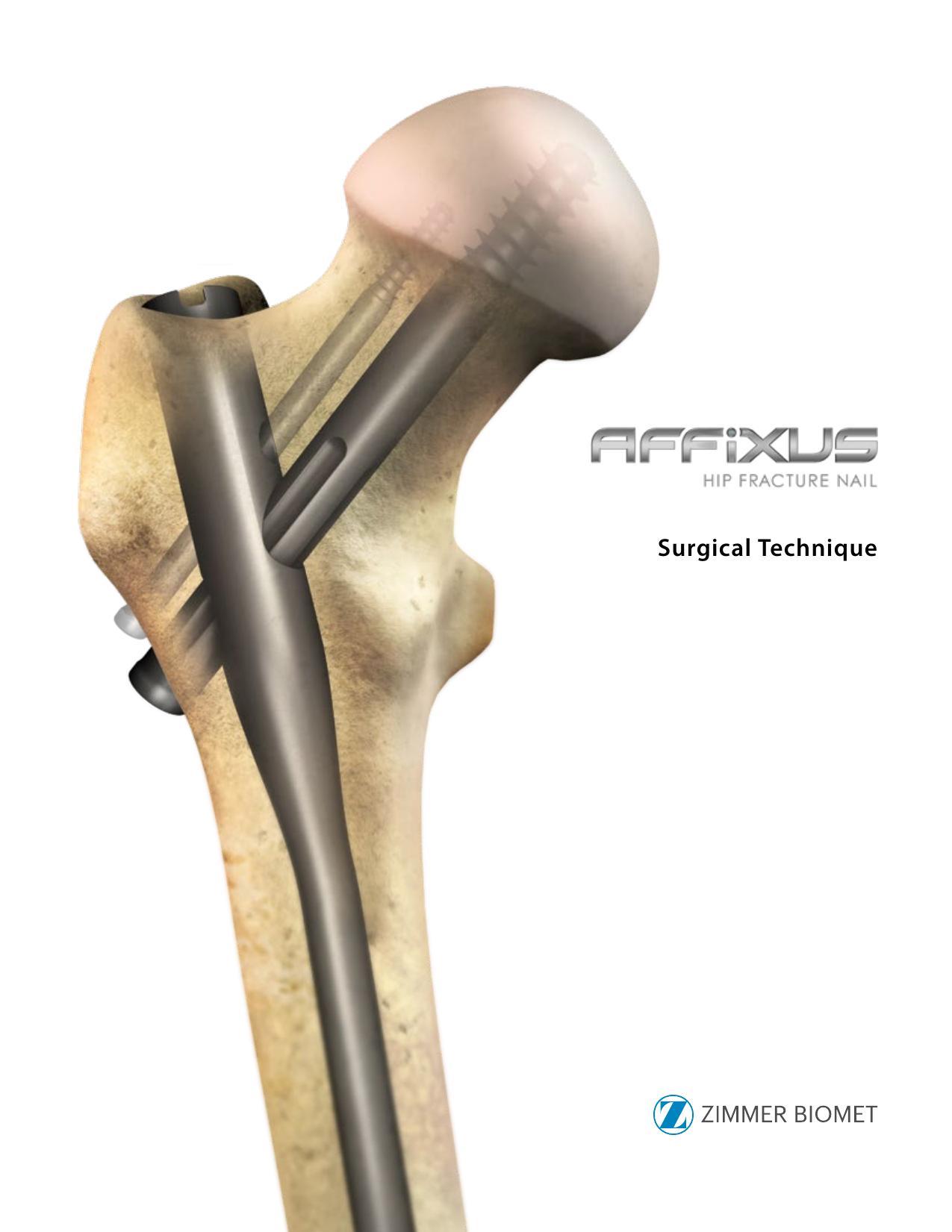 affixus-hip-fracture-nail-surgical-technique.pdf
